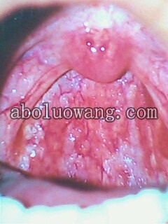 第一次被下毒，一个月后才拍的喉咙里症状照片，可想当时有多严重！