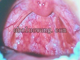 第一次被下毒，一个月后才拍的喉咙里症状照片，可想当时有多严重！